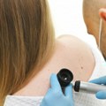 "Melanomi se pojavljuju i kod dece i adolescenata": Stručnjaci savetuju kako se zaštititi od raka kože