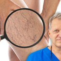 Da li posle operacije vena sme da se ide na more? Dr Jocić otkriva prve znake bolesnih vena i zašto ih leto razotkrije