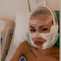 (Foto) operisala celo lice i evo kako izgleda: Ermina skinula zavoje, pukla 15.000 evra i promenila lični opis: Još uvek ima…