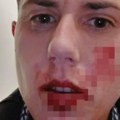 Uništeno i krvavo lice, jezive povrede: Isplivala slika isprebijane Matore, njena prijateljica otkrila istinu