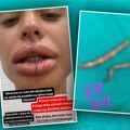 (Foto) "Obraćam se svim devojkama": Šok slike zadrugarke nakon vađenja silikona iz usana: "Zar ti je to bilo u ustima?"