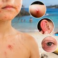 Među decom se šire „slatke kraste", ali more nije krivac Evo zašto se neke infekcije javljaju baš leti