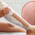 Jagodičaste noge: Kako da crne i crvene tačkice na koži nakon brijanja postanu prošlost, a koža ponovo savršeno glatka