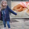 Devojčica rođena sa nogama okrenutim unazad sanja da postane gimnastičarka