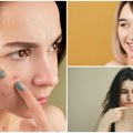 Šta vam akne zaista govore? Prema položaju bubuljica možete pročitati šta vašem telu nedostaje!