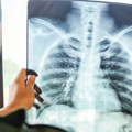 Batut: U Srbiji, u 2023. registrovano 476 obolelih od tuberkuloze