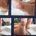 Uhapšen doktor i kozmetičar ordinacije "Beomedikus Beograd" zbog pogrešnog lečenja stopala kod pacijenta