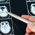 Moždani udar – Svaki minut je važan, a energetska pića i promena temperature opasni