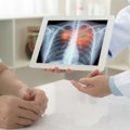 Skrining je ključan: Prepoznajte simptome karcinoma pluća