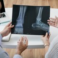 Revolucija u medicini: Popravka kostiju 3D pištoljem za lepak