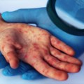 Upozorenje vodećeg američkog imunologa: Epidemija malih boginja je dokaz...