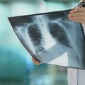 Od raka pluća i bronha u Srbiji godišnje oboli oko 7.000, a premine blizu 5.000 ljudi
