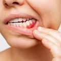 Zubobolja nije najgora stvar kod zuba! 2 simptoma su alarm za stomatologa: Nekoliko saveta kako da ublažite bolove