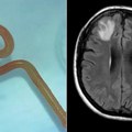 Horor! Ženi lekari iz mozga izvukli crva od 8 centimetara! Doktorima pozlilo - "Živo je i migolji se!" (foto)