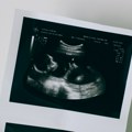 Nova šansa za parove kojima VTO nije uspevao: Uvodi se genetički skrining embriona, uzorak više neće morati da se šalje u…