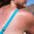 Znakovi raka kože mogu se razviti nakon samo 15 minuta provedenih na suncu