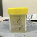 Lekari u mozgu Australijanke pronašli živog crva od osam centimetara