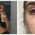Mlada žena popila lek protiv bolova koji Srbi masovno koriste: Pala u komu, oslepela na jedno oko: "Kao da gorim iznutra"…