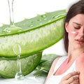 Kada aloja vera pomaže, a kada je treba preskočiti zbog opekotina od sunca: Umirujući pomoćnik kože nije za sve