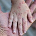 Opaka zarazna bolest hara Evropom: Izdato upozorenje građanima pre odlaska na odmor FOTO