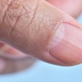 Nestanak ili izmenjena boja polumeseca na noktima: Kada su lunule rani znak bolesti