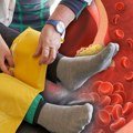 Одраз високог холестерола на ногама и стопалима: Игнорисање симптома периферне артеријске болести води у губитак екстремитета