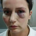 “Najviše me udarao u glavu šakama” Podignuta optužnica protiv vlasnika hotela u BiH koji je pretukao Enisu Klepo