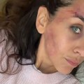 Ivana Dudić sa modricama i ogrebotinama na licu zabrinula pratioce: Glumica otkrila šta joj se dogodilo