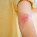"Nije svako crvenilo atopijski dermatitis"; Doktorka otkrila najčešću grešku u lečenju