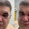 "Spremam se za operaciju, ruka mi je polomljena na tri mesta" Prvo oglašavanje Saše Mirkovića nakon što je napadnut (video)
