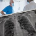 Inovativna terapija karcinom pluća pretvara u hroničnu bolest