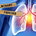 Simptomi plućne fibroze: Ključno je prepoznati je na vreme jer može biti opasnija od mnogih karcinoma