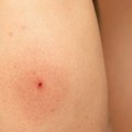 Tularemija - tiha opasnost iz prirode: Kako razlikovati zečju groznicu od običnog virusa, prvih 24 sata su ključni za oporavak…