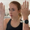 Devojku izujedale stenice u poznatom hotelu: Objavila fotografije tela, izgledaju jezivo