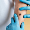 Regionalni skup o melanomu: Srbija još daleko od standarda Evropske unije