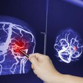 Novo otkriće šta zaista uzrokuje najčešći moždani udar: nisu krive začepljene arterije već oštećeni krvni sudovi u mozgu…