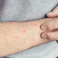 Peta žrtva groznice Zapadnog Nila u Severnoj Makedoniji: Preminuo muškarac (73), četiri pacijenta kritično