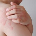 Dugotrajna i svakodnevna borba sa svrabom: Kako hronična spontana urtikarija pretvara život u noćnu moru