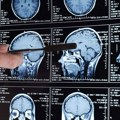 Nova terapija izlečila četvoro dece od tumora mozga: "Ovi mališani su dobili još jednu priliku za život"