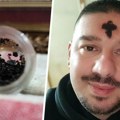 Nenad iz Pančeva sakuplja kraste sa svog čela u staklene posudice: Otkrio je šta radi s njima