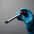 U Srbiji skoro 600 osoba boluje od hemofilije: Neizlečiva bolest zgrušavanja krvi