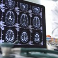 Naučnici razvili metod koji produžava dejstvo lekova protiv tumora mozga
