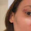 "Udario me, isekao": Kristini Spalević pukla arkada, hitno se oglasila i pokazala modricu!