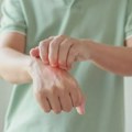 Svetski dan borbe protiv psorijaze: U Srbiji 140.000 obolelih
