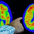 Australija odobrila prvi lijek za liječenje Alzheimerove bolesti