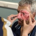 Povređeni biciklista dobija novo 3D lice