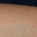 Novi slučajevi šuge u vrtićima Kod male dece je koža mekša i podložnija, kaže dermatolog, a infekcija obično napada šačice…