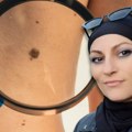 Afroditina priča o borbi sa melanomom: Trudim se da mladima skrenem pažnju na značaj prevencije