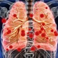 Život sa cističnom fibrozom nije bauk – inovativna terapija za bolje zdravlje