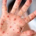 U Kantonu Sarajevo proglašena epidemija morbila